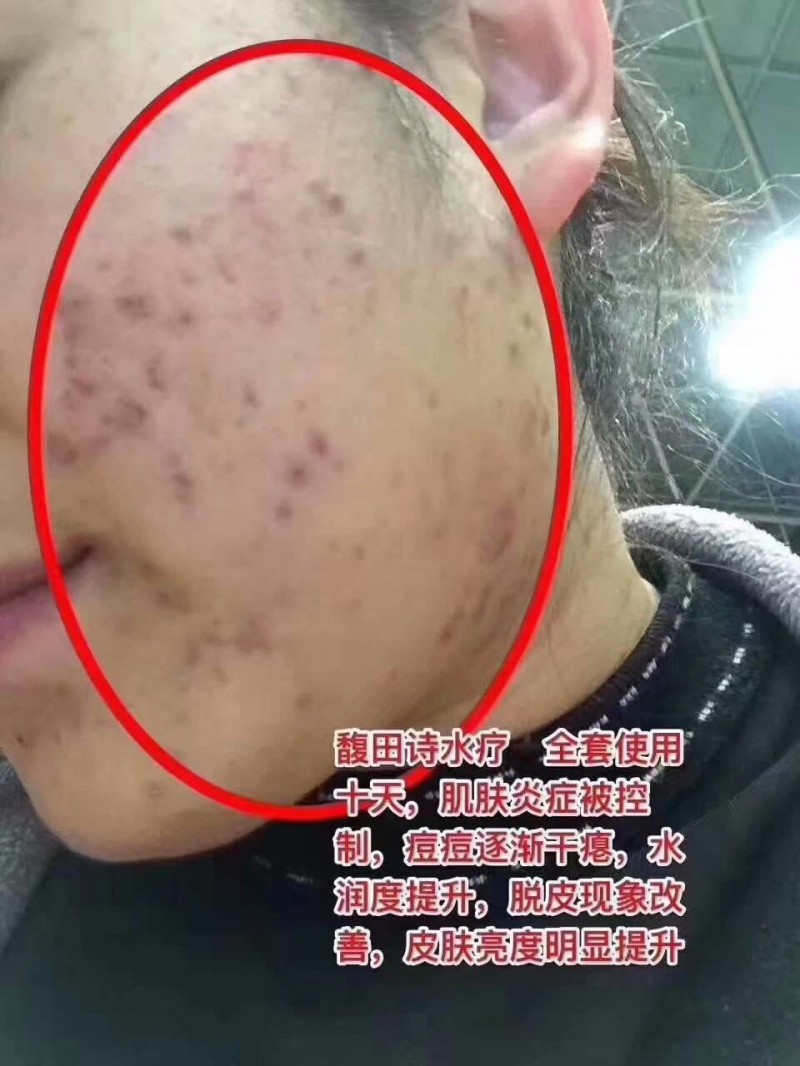 馥田詩水療,全套使用十天,肌膚炎癥被控制,痘痘逐漸干癟,水潤度提升,脫皮現(xiàn)象改善,皮膚亮度明顯提升。